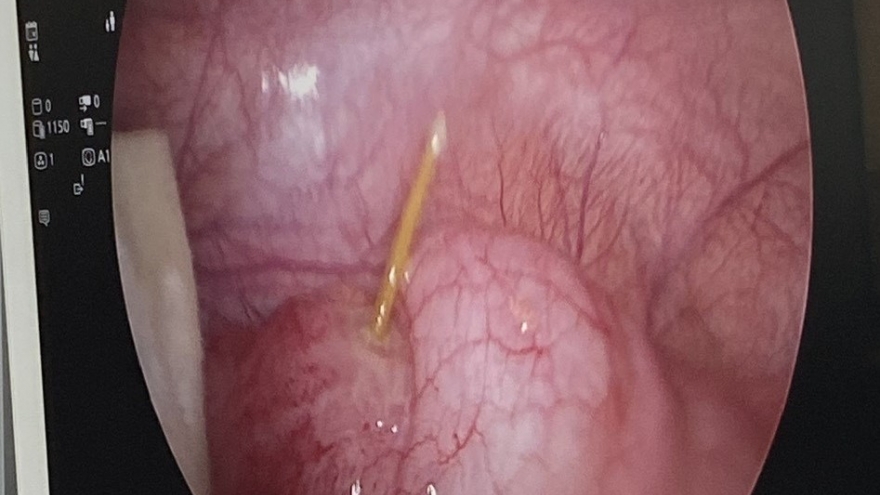 Phẫu thuật bệnh nhân nuốt cây tăm tre vào bụng đâm thủng manh tràng